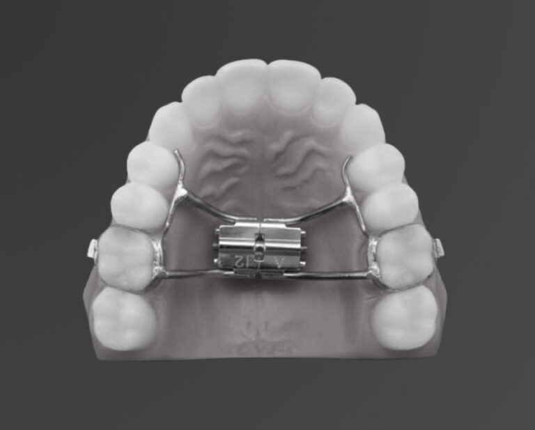 Palatal Expanders